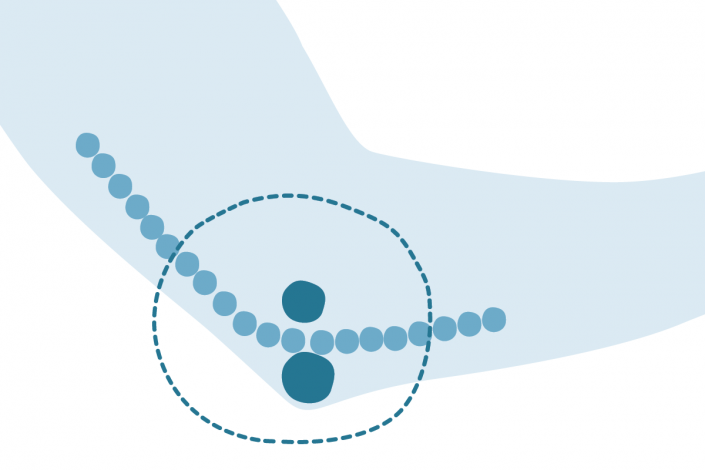 SUS (SulcusUlnarisSyndrom) Dr. Marweh Schmitz